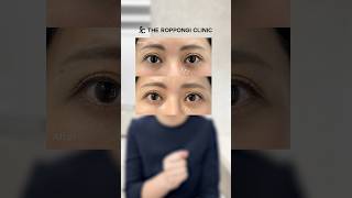 【若返り美容医療】目周りのくぼみやボリュームがなくなってきてしまい、老けてみえるとお悩みの方の嬉しい変化！＃美容皮膚科#美容外科#美容クリニック #ザロク式似合わせヒアルロン酸#ヒアルロン酸