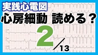 【心電図 読み方 ②】心房細動