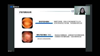 20211113贾研 子宫内膜炎与反复流产