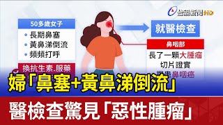 婦「鼻塞+黃鼻涕倒流」 醫檢查驚見「惡性腫瘤」