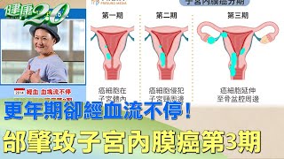 更年期卻經血流不停！邰肇玫子宮內膜癌第3期 健康2.0