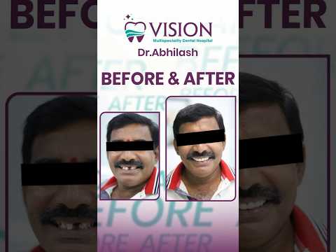 Venkateswar Rao, a happy client of Vision Dental Hospital ! 🎉with severely damaged teeth !!