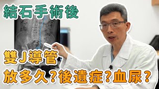 【平安醫館】結石手術後，雙J導管要放多久?有甚麼後遺症?血尿正常嗎?