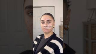holy fkn air ball… 👏🏼 #acneskin #hormonalacne #acnefighter #acnetreatment #acnejourney #acneprone
