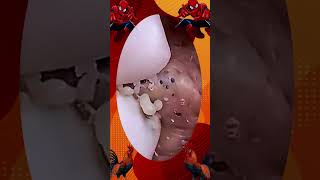 Blackheads Removal | Acne Treatment and Very Satisfying Satisfying Pimple pop #blackheads
