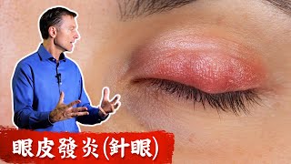 眼皮發炎,針眼的自然療法,柏格醫生 dr berg