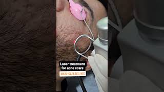 #lasertreatment #skincare #acneawareness #acnescars