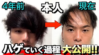 【4年間でおでこ/生え際がすごい事に】ハゲはどれだけ進行したのか？YouTubeを始めてからの過去を振り返ってみた