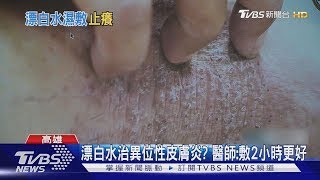 係金ㄟ! 漂白水治療異位性皮膚炎 醫師 病友說話了｜TVBS新聞