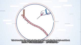 Stemlife - How Is Your Babys Cord Blood Cord Lining Collected With StemLife