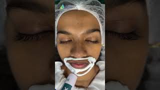 Viscoderm treatment at #skinfinityderma #dermatologyclinic #dermaworlddelhi #gurgaon #dermatologist