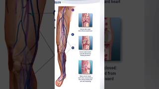 Vascular surgery #doctortips #information #healthytips #healthiswealth #shortsviral #shorts #2024